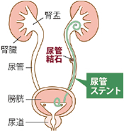 腎盂腎炎