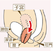 骨盤臓器脱（上）