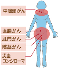 子宮筋腫男性もＨＰＶワクチンを