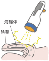 ＥＤの最新治療