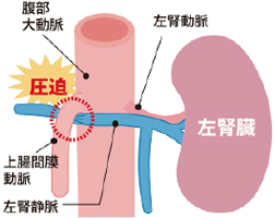 ナットクラッカー症候群