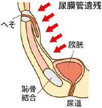 尿膜管遺残