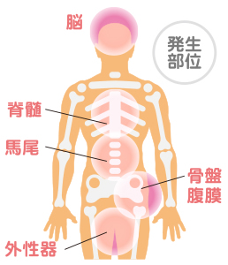 持続性性喚起症候群（下）