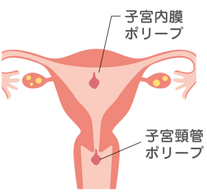 子宮出血とポリープ