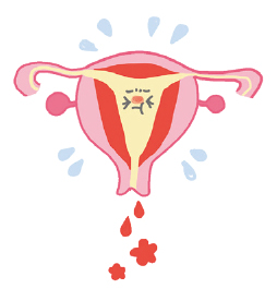 子宮内膜増殖症