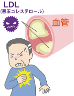 高コレステロール血症