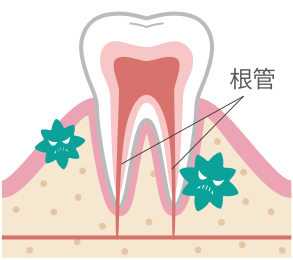 根管治療