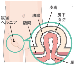 鼠径ヘルニア（上）